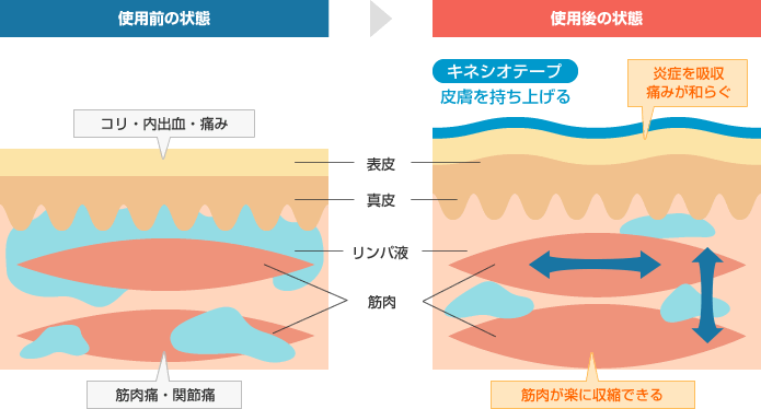 キネシオテープの効果